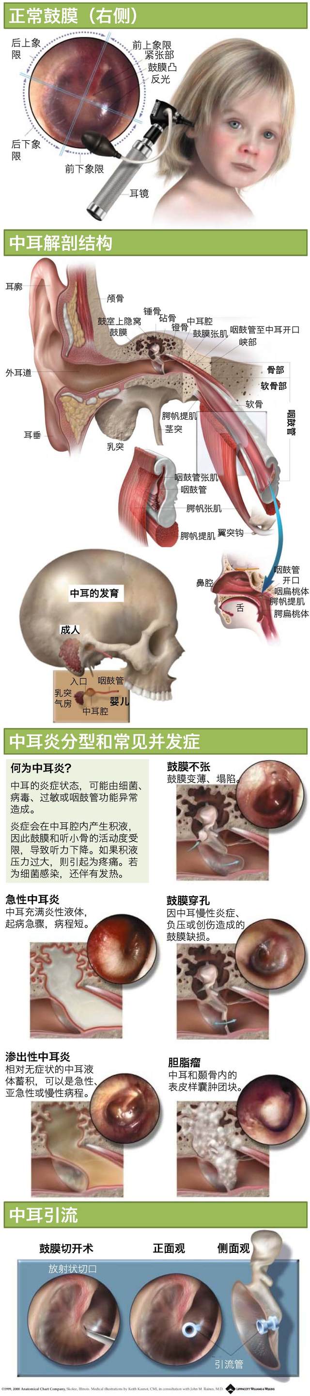一图读懂—中耳炎