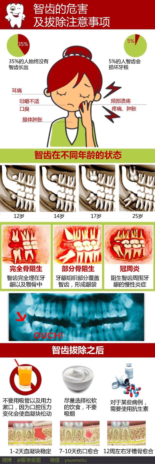 一图读懂—恼人的智齿