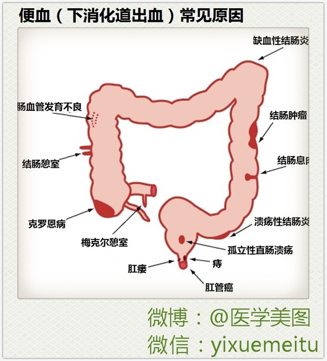 一图读懂 l 便血（下消化道出血）常见原因
