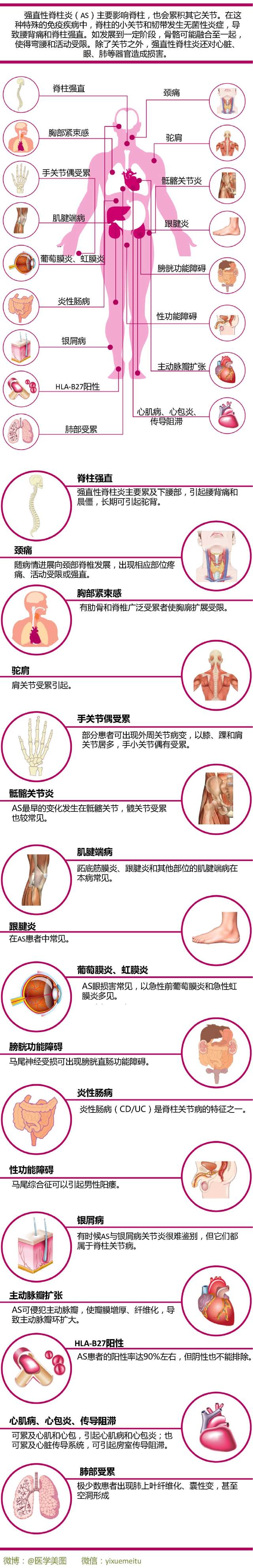 一图读懂—强直性脊柱炎