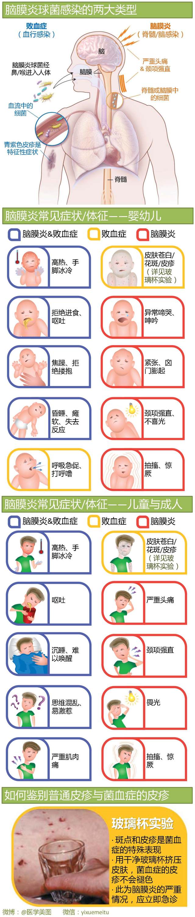 一图读懂—及时识别脑膜炎