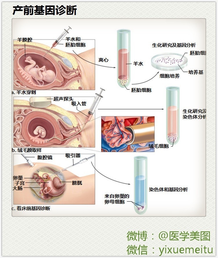 一图读懂—产前基因诊断