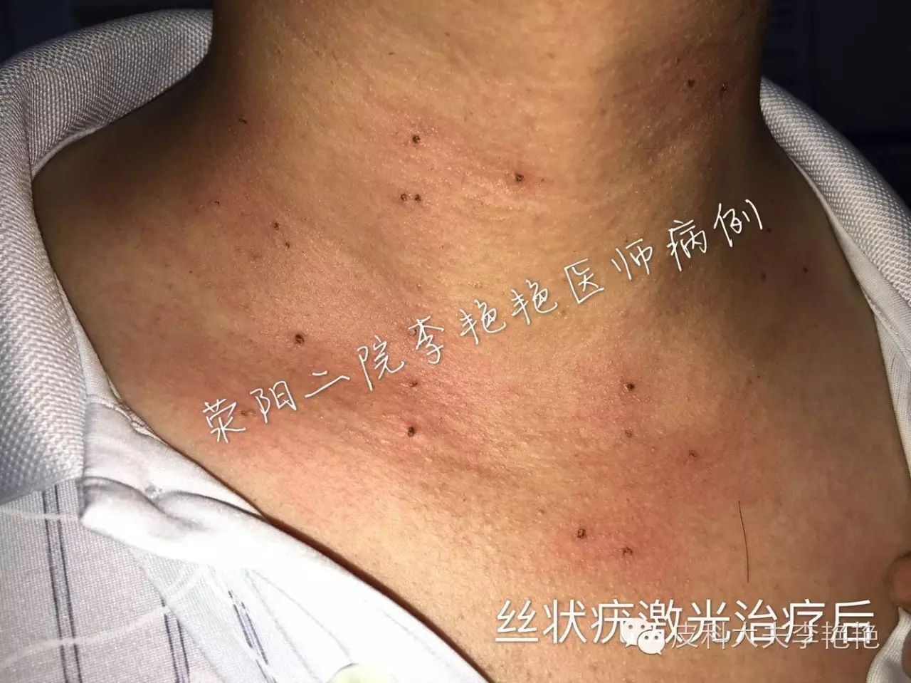 丝状疣是由人类乳头瘤病毒(hpv)所致的感染性疾病 皮损表现为褐色或