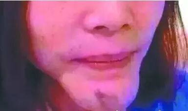 想要一个angelababy那样的下巴,女子打了一针,结果下巴...