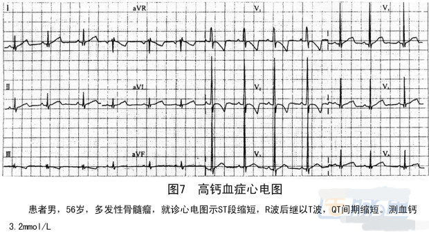 1 主要心电图改变①st段平直延长,无上下偏移;②t波直立,当血钙严重降