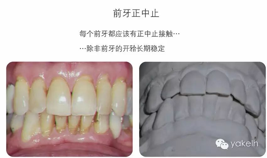 稳定的开牙合是指开状态存在多年而无变化.