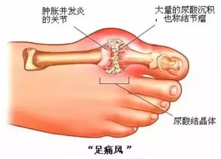 中国灸痛风为何从脚起？病因居然是因为这个？