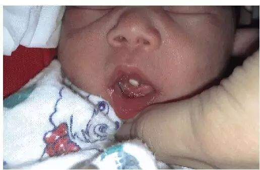 吓人!刚出生宝宝竟长了牙,医生10秒拔掉了它…怀孕时你们也在干这事!-怀孕期