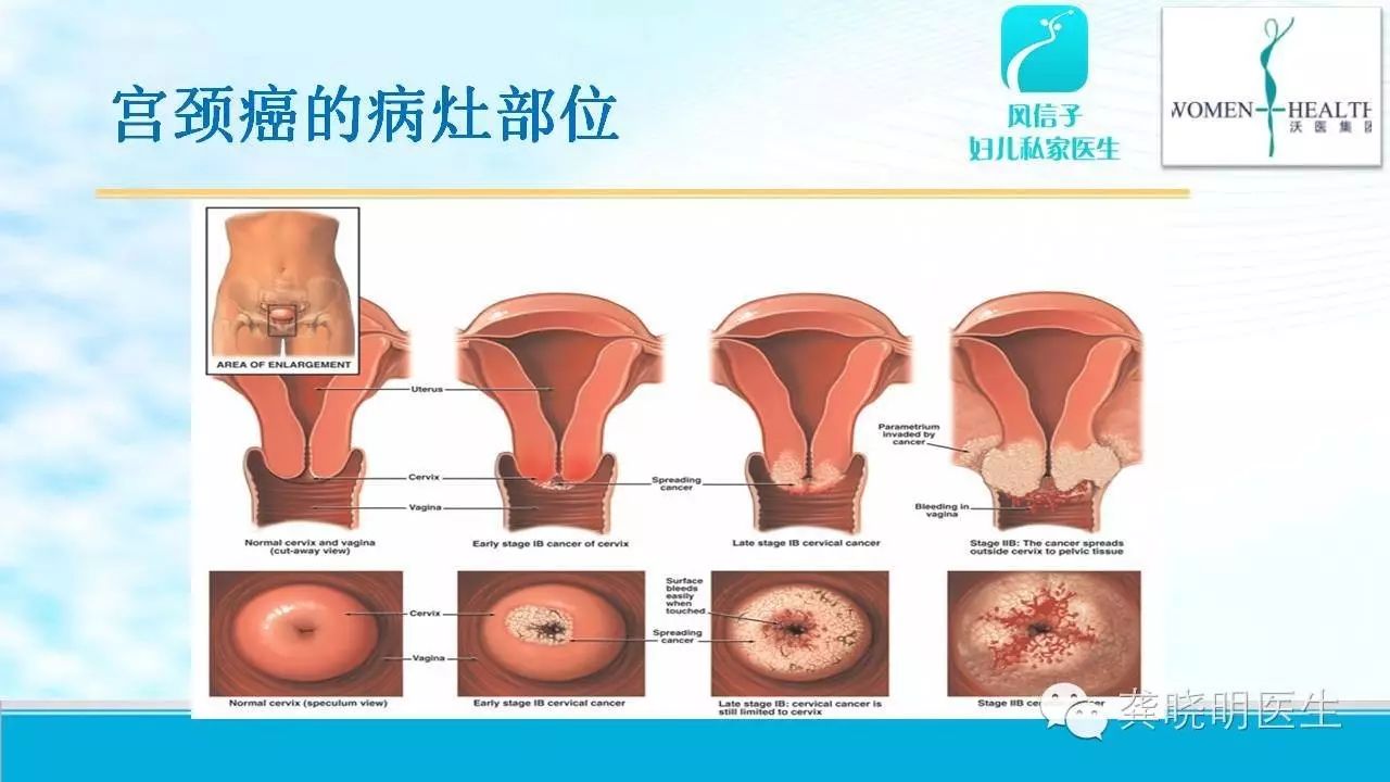 30岁以上女性重视hpv筛查 子宫脱垂阴道壁膨出了怎么办 hpv感染,没
