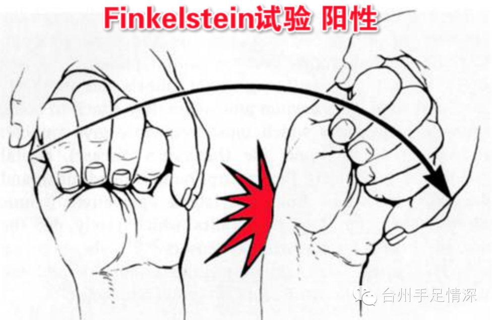 (医学上称finkelstein试验 阳性) 常见的腱鞘炎好发于长期,持续使用