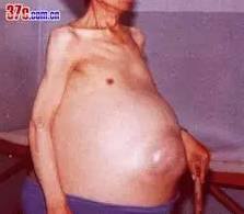 为什么肝癌一发现就是晚期？你“肝”净吗？不护好肝，以后别后悔喽！