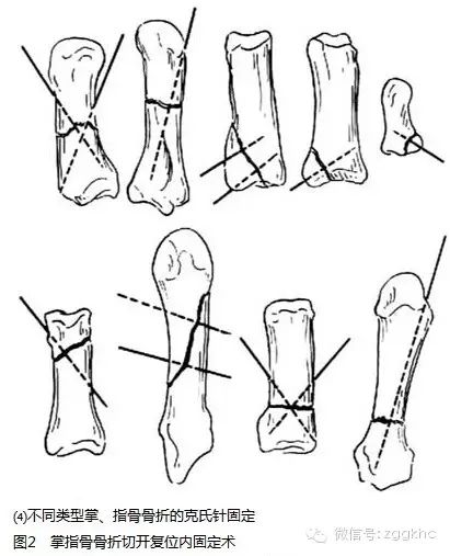 掌,指骨骨折切开复位内固定术