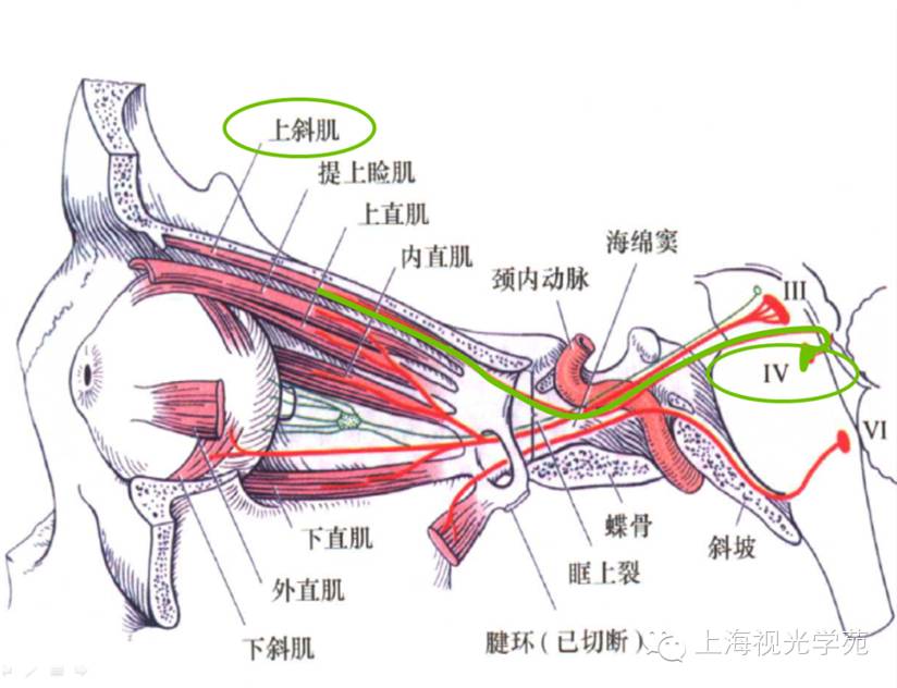 【上海视光学苑微信公开课】上斜肌麻痹的诊断与治疗