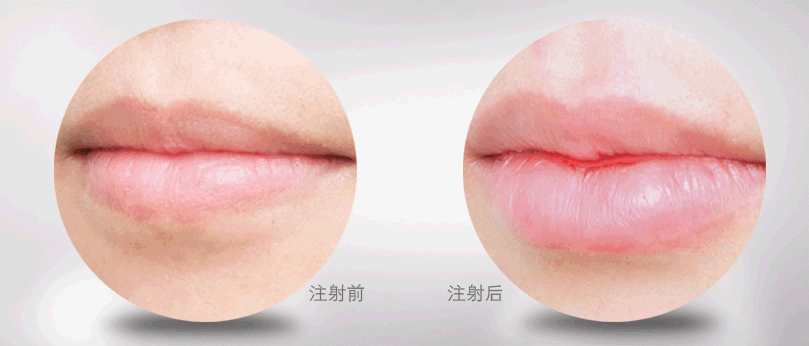 (3)自体脂肪丰唇整形