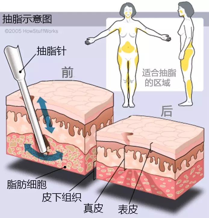 减肥太辛苦了可以选择抽脂吗