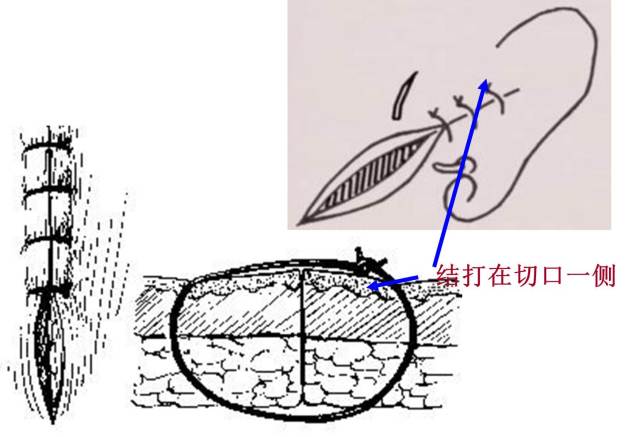 医疗缝线怎么做超全秘籍：临床常用伤口缝合方法（文字+图示+视频）_https://www.jmylbn.com_新闻资讯_第6张