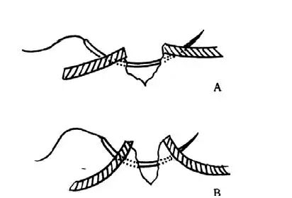 医疗缝线怎么做超全秘籍：临床常用伤口缝合方法（文字+图示+视频）_https://www.jmylbn.com_新闻资讯_第17张