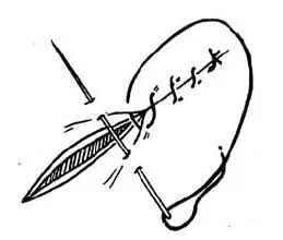 医疗缝线怎么做超全秘籍：临床常用伤口缝合方法（文字+图示+视频）_https://www.jmylbn.com_新闻资讯_第12张