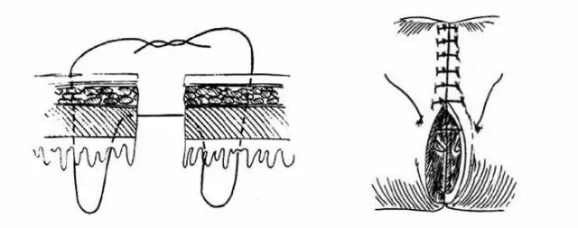 医疗缝线怎么做超全秘籍：临床常用伤口缝合方法（文字+图示+视频）_https://www.jmylbn.com_新闻资讯_第8张