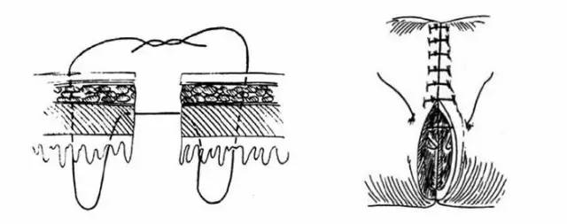 开放伤口的缝合方法