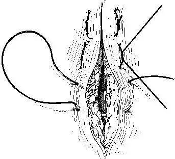 医疗缝线怎么做超全秘籍：临床常用伤口缝合方法（文字+图示+视频）_https://www.jmylbn.com_新闻资讯_第19张