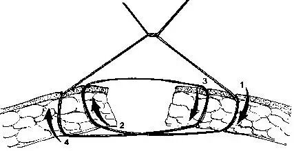 医疗缝线怎么做超全秘籍：临床常用伤口缝合方法（文字+图示+视频）_https://www.jmylbn.com_新闻资讯_第20张