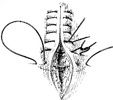 医疗缝线怎么做超全秘籍：临床常用伤口缝合方法（文字+图示+视频）_https://www.jmylbn.com_新闻资讯_第16张