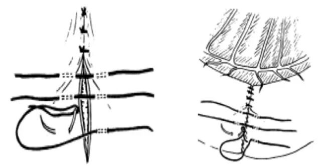 医疗缝线怎么做超全秘籍：临床常用伤口缝合方法（文字+图示+视频）_https://www.jmylbn.com_新闻资讯_第11张