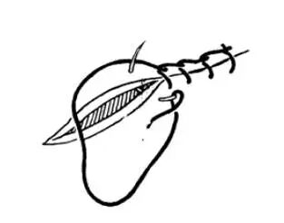 医疗缝线怎么做超全秘籍：临床常用伤口缝合方法（文字+图示+视频）_https://www.jmylbn.com_新闻资讯_第10张