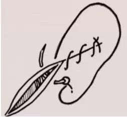 医疗缝线怎么做超全秘籍：临床常用伤口缝合方法（文字+图示+视频）_https://www.jmylbn.com_新闻资讯_第7张