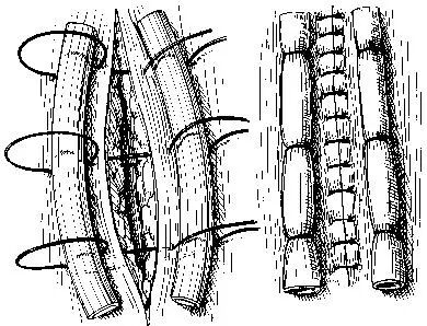 医疗缝线怎么做超全秘籍：临床常用伤口缝合方法（文字+图示+视频）_https://www.jmylbn.com_新闻资讯_第18张