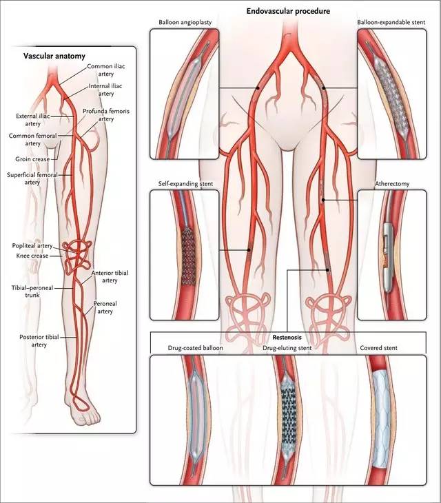 图3. 下肢动脉的解剖及腔内治疗
