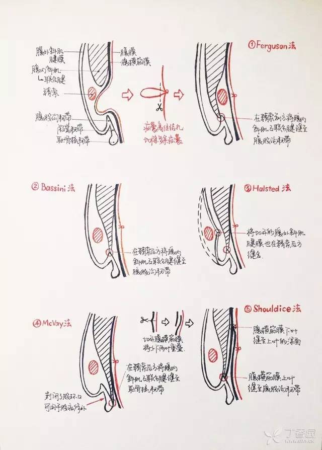 7. 腹股沟疝传统修补方法