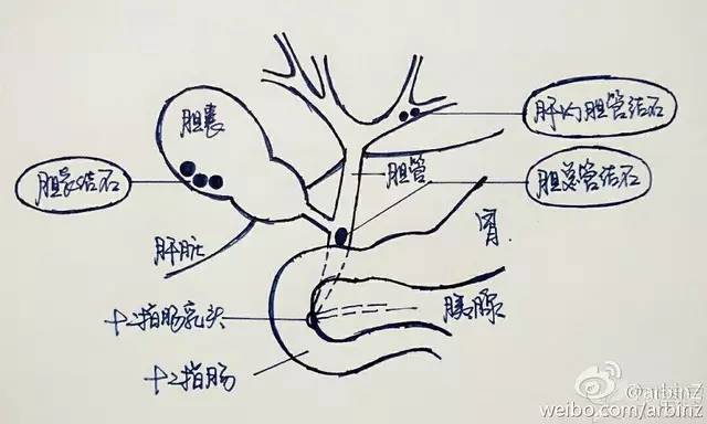 杭州大妈的胆囊里满是结石 手术后取出上百颗