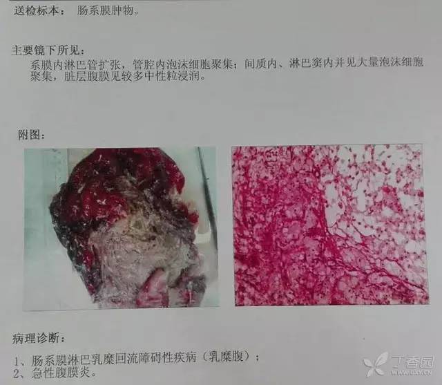 男人肚子变大未必是「啤酒肚」(临床病例分析)