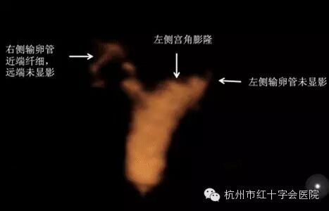 准备怀孕的你,输卵管通畅吗?-怀孕期