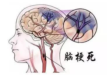 【悬吊康复训练】脑梗死、脑血栓及脑出血术后康复方案(图1)
