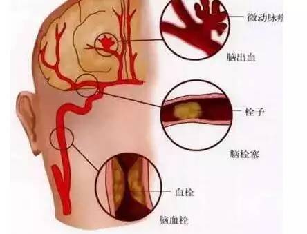 【悬吊康复训练】脑梗死、脑血栓及脑出血术后康复方案(图2)