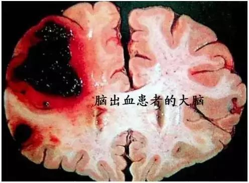 【悬吊康复训练】脑梗死、脑血栓及脑出血术后康复方案(图3)