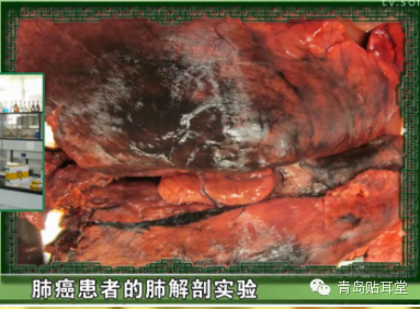 耳穴戒烟