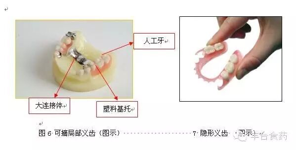 什么是定制式义齿您知道定制式义齿是什么吗？_https://www.jmylbn.com_新闻资讯_第6张