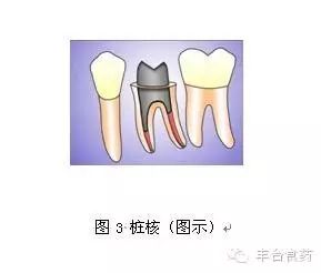 什么是定制式义齿您知道定制式义齿是什么吗？_https://www.jmylbn.com_新闻资讯_第3张