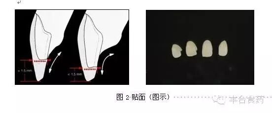 什么是定制式义齿您知道定制式义齿是什么吗？_https://www.jmylbn.com_新闻资讯_第2张