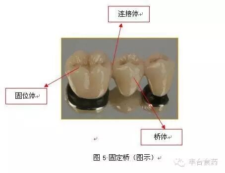 什么是定制式义齿您知道定制式义齿是什么吗？_https://www.jmylbn.com_新闻资讯_第5张