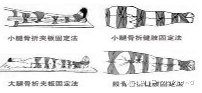 ( 五)小腿骨折固定