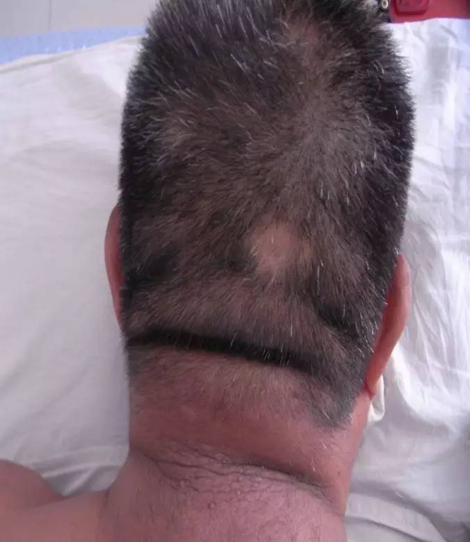 下图这位患者的颈头结合处有条深沟,枕骨下是一个脂肪大包突出来