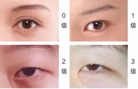 要想解决内眦赘皮这种情况