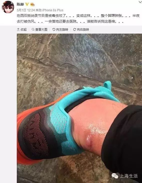 超级涨姿势  陈赫被毒虫咬,整个脚踝肿得像猪蹄!这种虫...