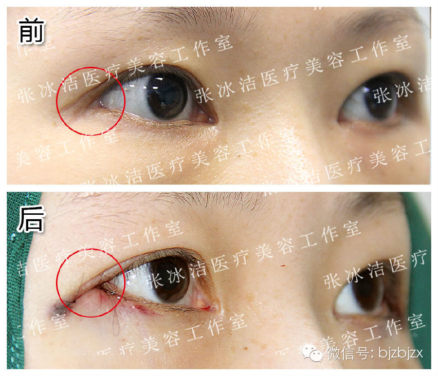 因为外眼角处的皮肤非常薄,伤口血液循环不好,一定要遵守医生嘱咐,不