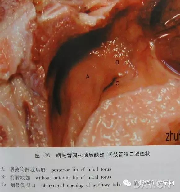 咽鼓管前唇缺如